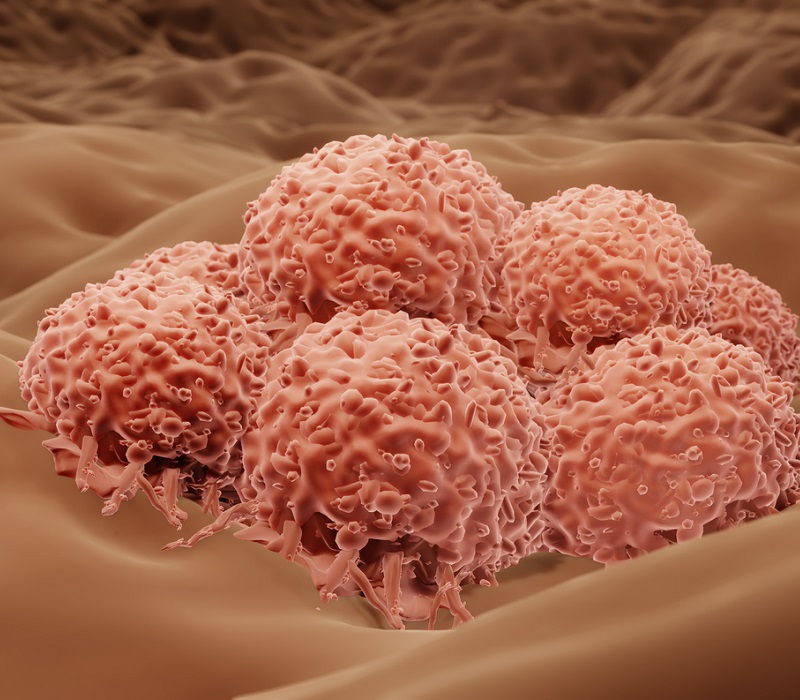Cómo se detecta el ganglio centinela en el melanoma