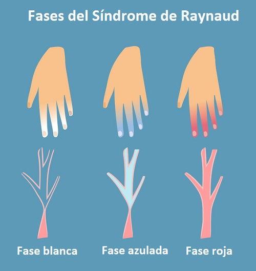 Síndrome de Raynaud: Fases o cambios de color en los dedos