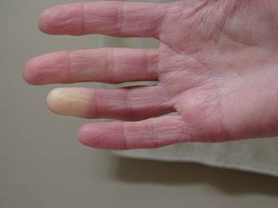 Una mano con los dedos blancos por el fenómeno de Raynaud