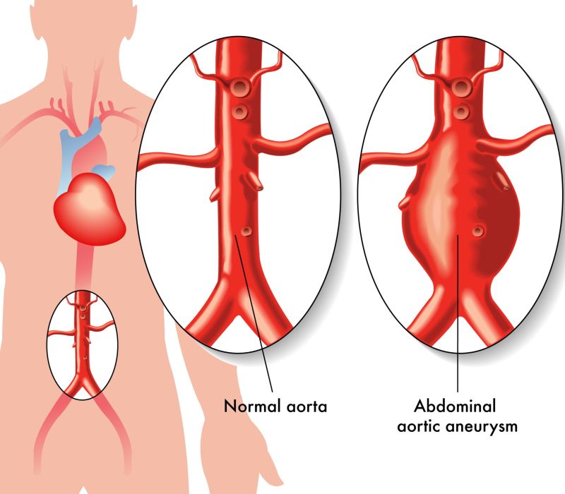 Técnica pionera para el tratamiento del aneurisma de aorta abdominal