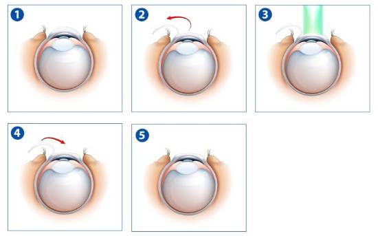 Esquema del proceso de cirugia refractaria por láser