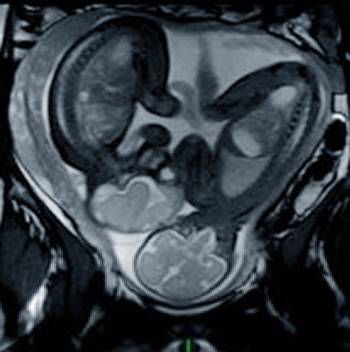 diagnostico-resonancia-magnetica-fetal