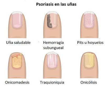 Psoriasis en las uñas