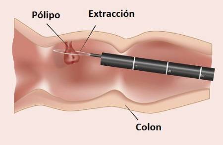 Extracción de pólipos mediante la colonoscopia