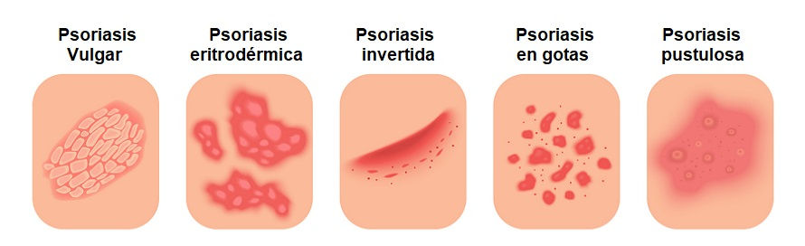 Tipos de psoriasis: cómo son las lesiones