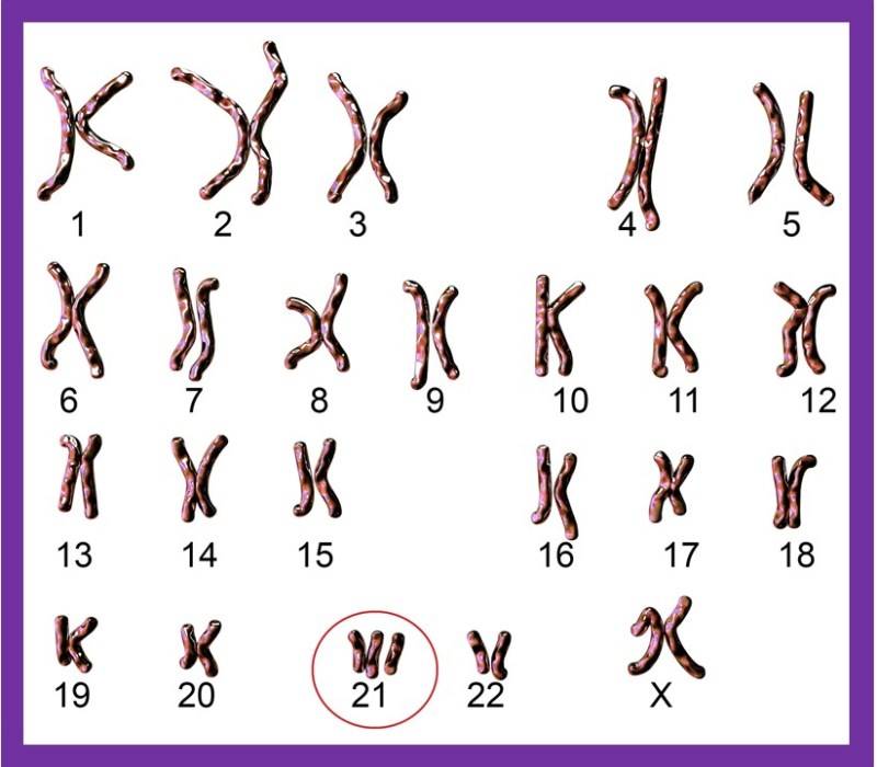Trisomía en el cromosoma 21