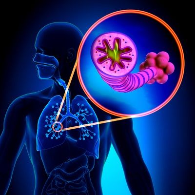 EPOC o Enfermedad pulmonar obstructiva crónica