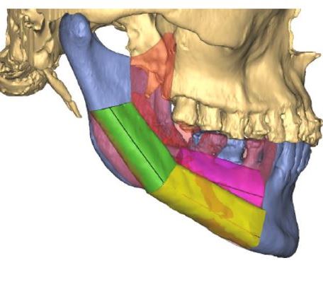 Reconstrucción de mandíbula por diseño 3D