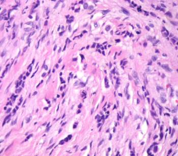 Células neooplásicas de tejido mamario
