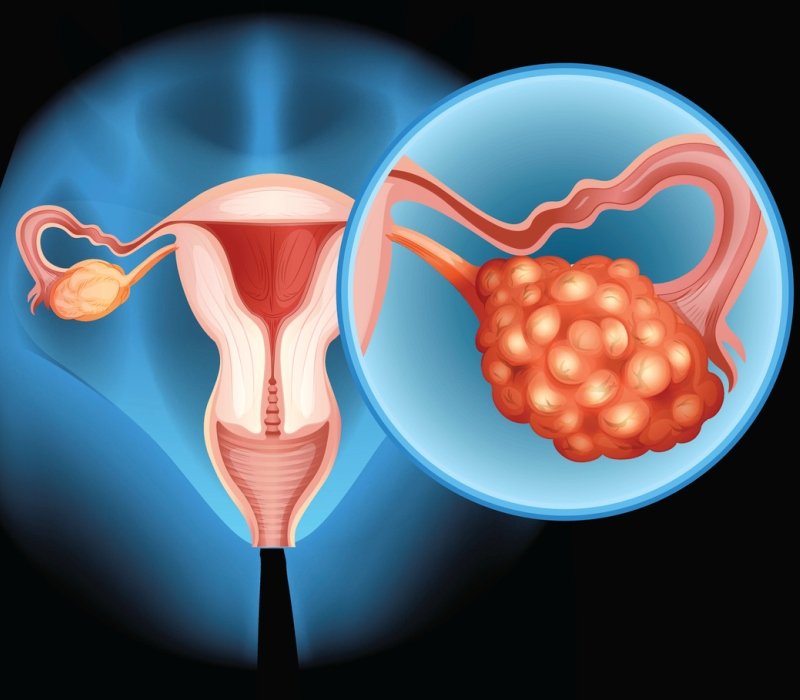 Ilustración del cáncer de ovario