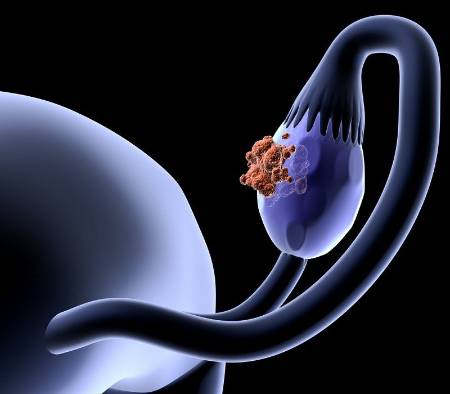 Cáncer de ovario y el riesgo hereditario