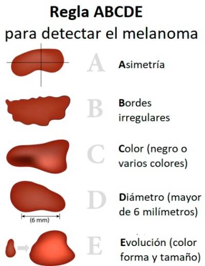 Regla ABCDE para detectar posibles melanomas