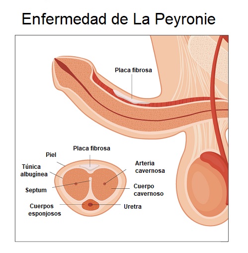 Ilustración de la anatomía de un pene con la enfermedad de La Peyronie