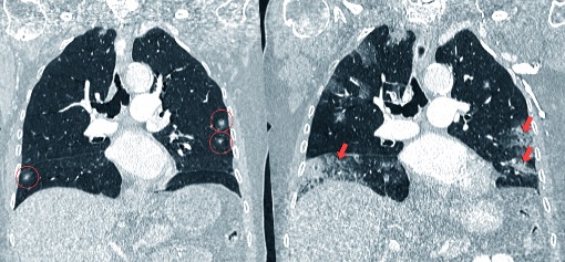 Evolución de un cáncer de pulmón por tomografía