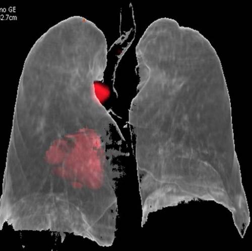 Imagen PET del tumor en el pulmón