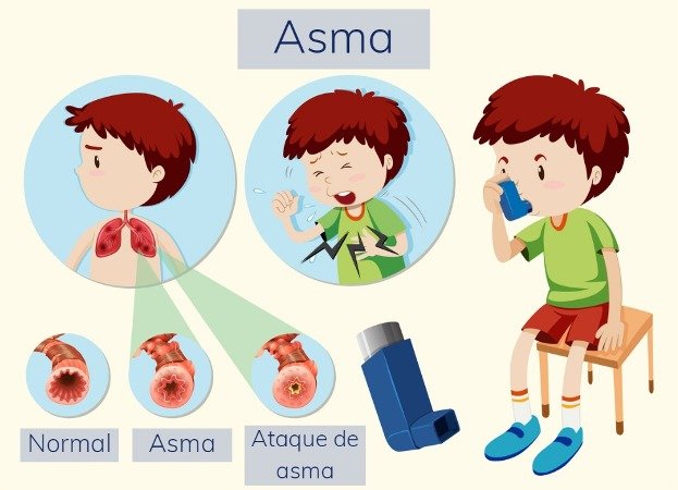 Representación de un ataque de asma