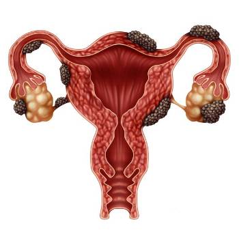 Ilustración de la enfermedad de endometriosis