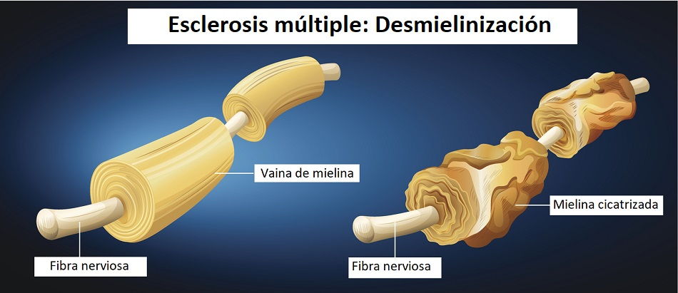 Deterioro de la mielina en la esclerosis múltiple