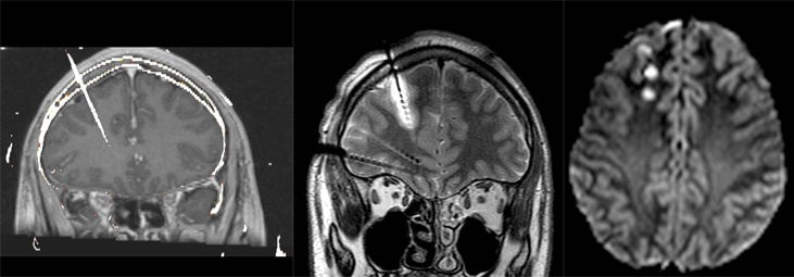 Las primeras imágenes muestran la implantación de un electrodo mostrando una lesión. En la última imagen se observan lesiones pequeñas generadas por el procedimiento.