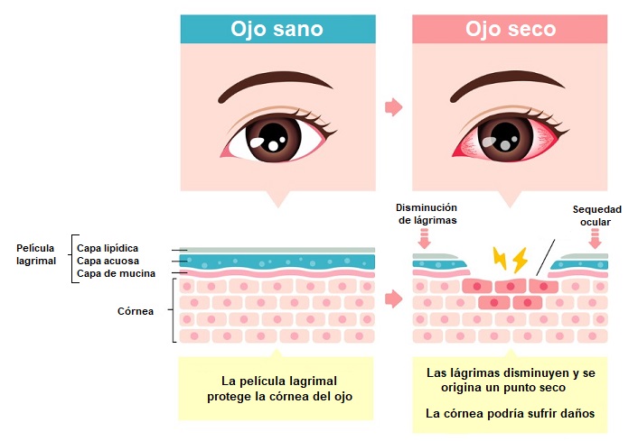 Ilustración que compara el ojo sano con el ojo seco