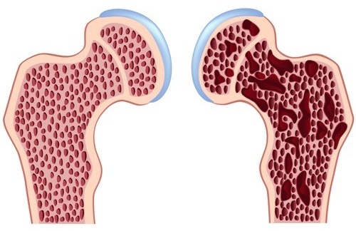 diferencia entre un hueso sin y con osteoporosis