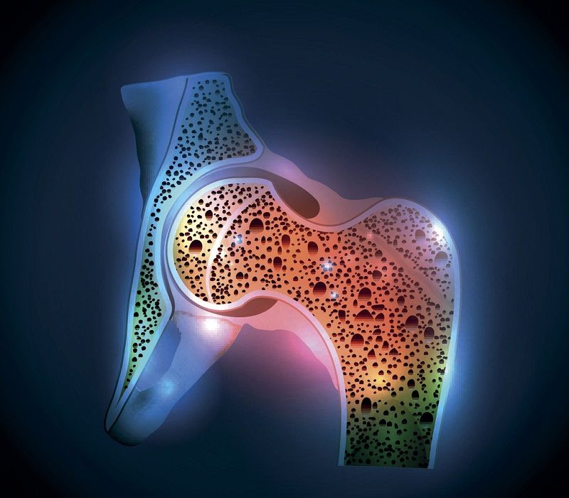 Osteoporosis y el riesgo de las fracturas de hueso