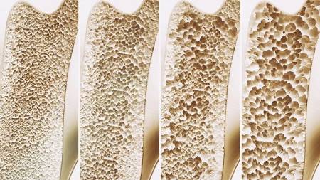 Las 4 etapas de la osteoporososis
