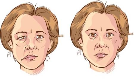 Efectos de la parálisis facial