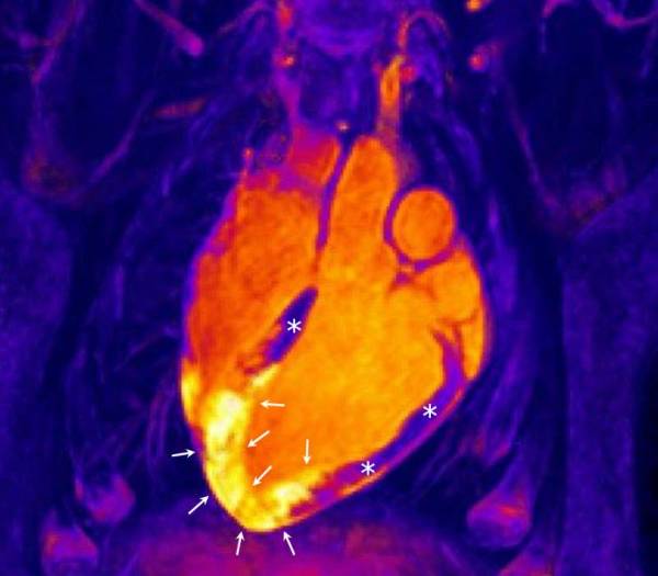 Resonancia magnética 3D del corazón tras un infarto