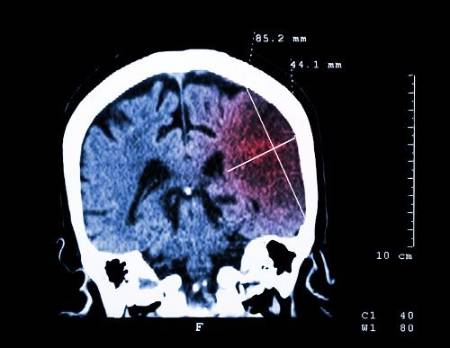 Escáner cerebral del tipo de ictus isquémico