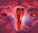 Síntomas y riesgos del síndrome de ovario poliquístico