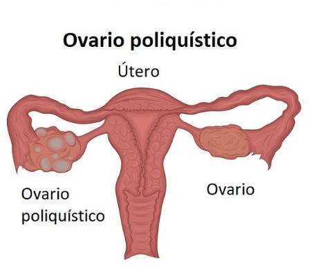 Ilustración de ovario poliquístico en el útero comparado con un ovario sano