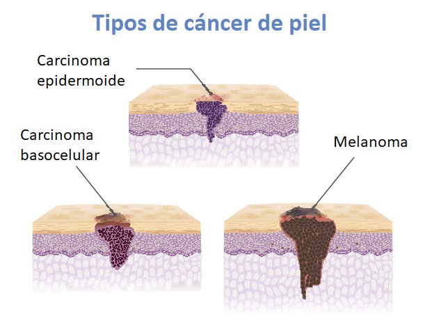 Ilustración con los tres tipos de cáncer de piel
