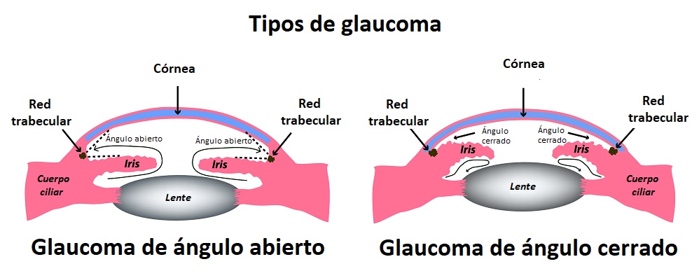 Diferencias entre los dos tipos de glaucoma