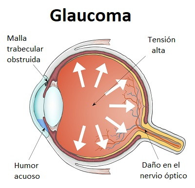 Ilustración del glaucoma