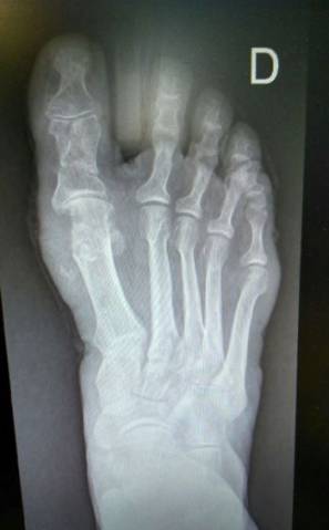 Resultado de la cirugía en el pie