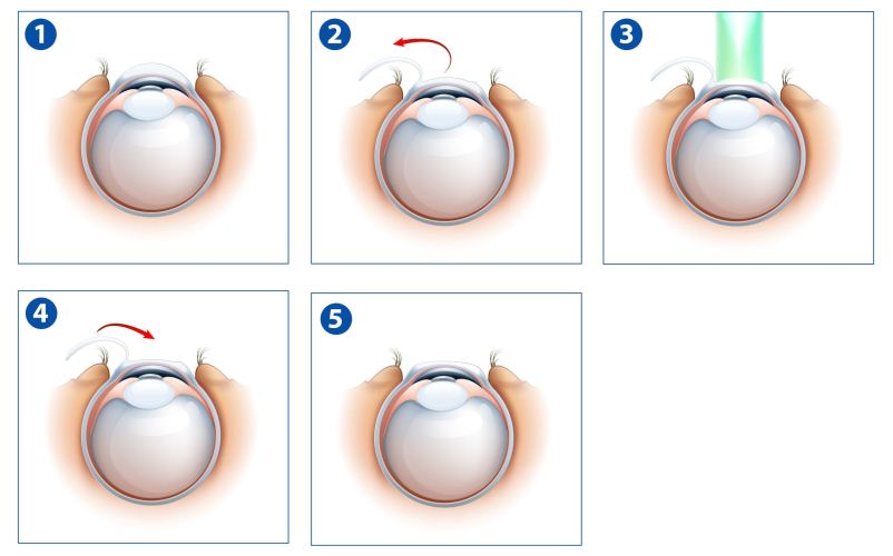 Esquema del proceso de cirugia refractaria por láser