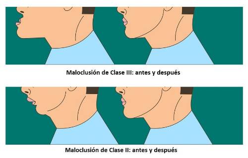 Maloclusiones de la mandíbula, de Clase II y Clase III