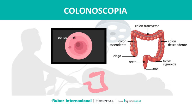 Infografía de colonoscopia