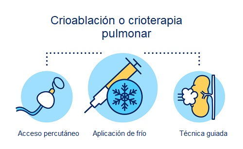 Uso de crioablación o crioterapia para tratar el cáncer de pulmón