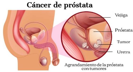 Detección de los problemas de próstata | Tu canal de salud