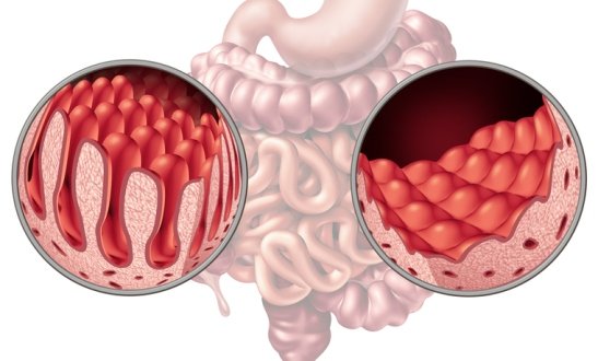 Ilustración de intestino sano y con celiaquía