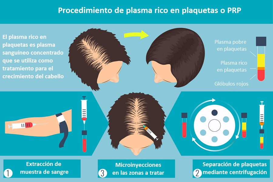 Cómo se aplica el plasma rico en plaquetas en el cuero cabelludo