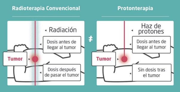 Radiación convencional comparada con protonterapia