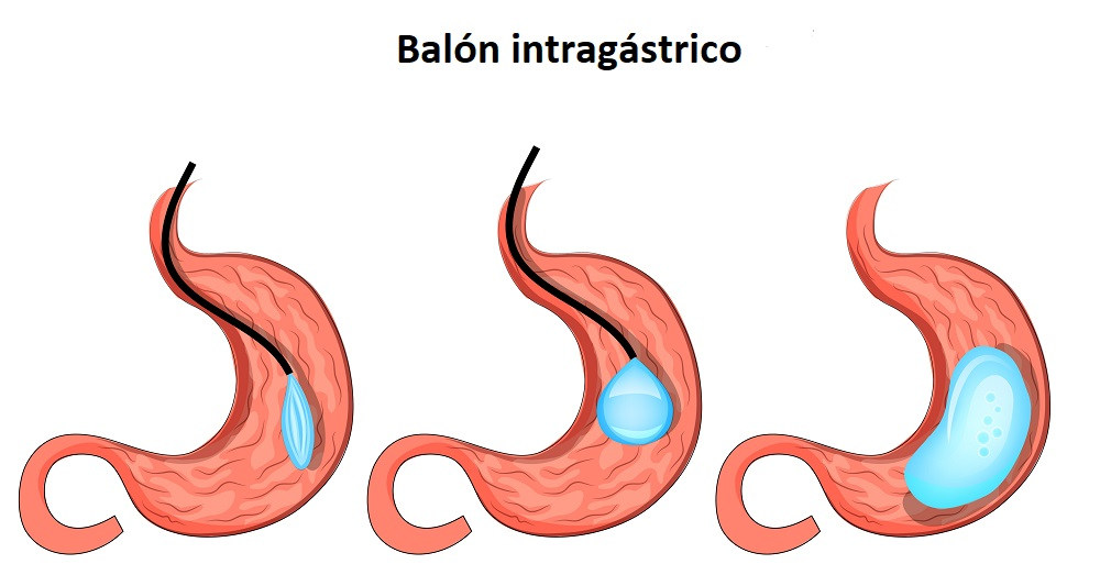Colocación del balón intragástrico en el interior del estómago