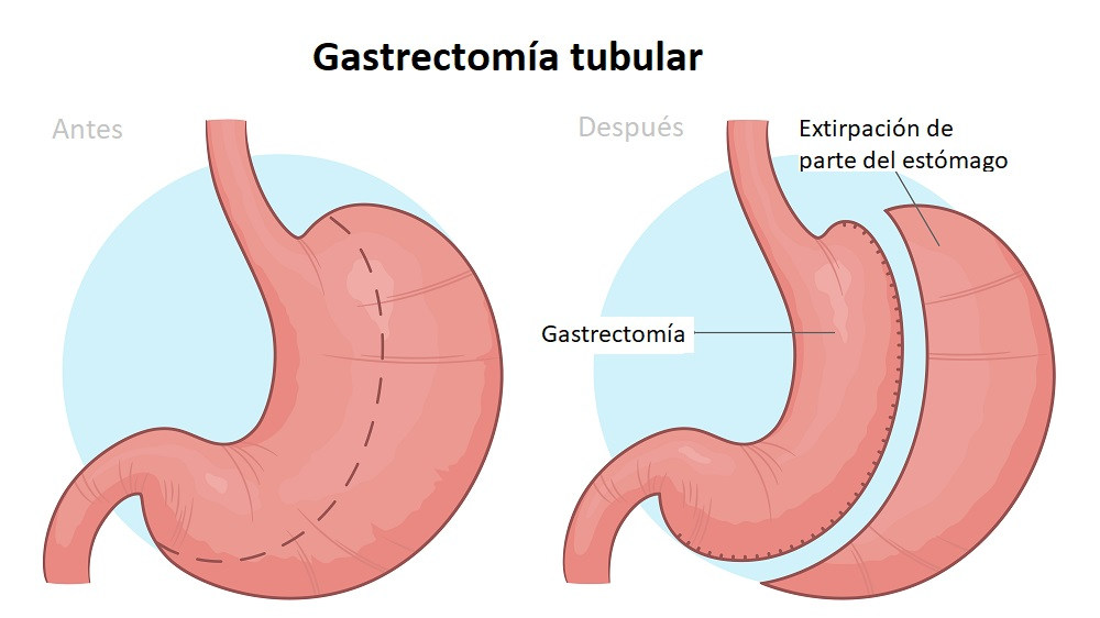 Antes y después de la operación de gastrectomía tubular