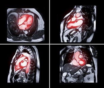 Imágenes de la resonancia magnética cardiaca