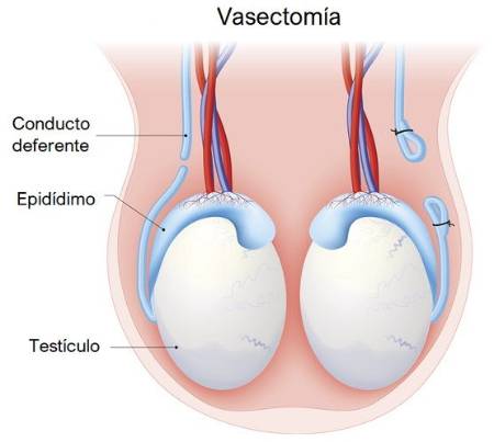Ilustración de cómo se realiza la vasectomía