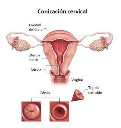 Conización cervical: cómo se realiza