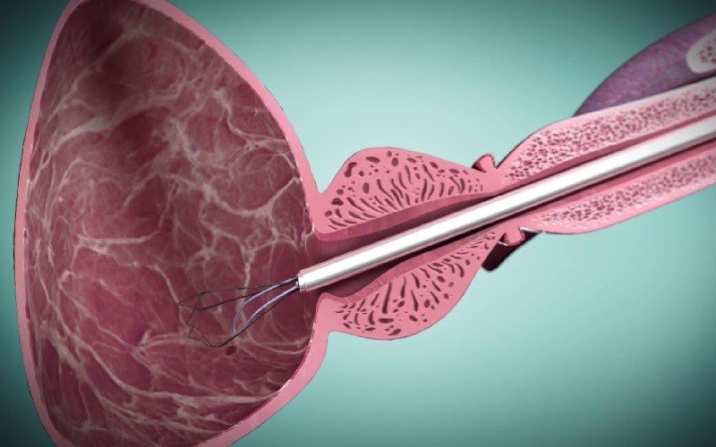 Tratamiento i-TIND para hiperplasia benigna de próstata